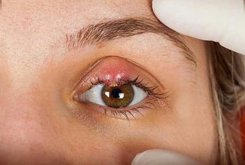 Mí phun bị nổi mụn nhỏ – nguyên nhân do đâu? 2 Mí phun bị nổi mụn nhỏ – nguyên nhân do đâu?