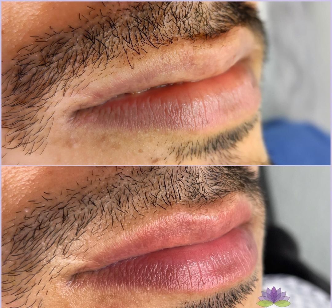 Khử thâm môi cho nam có bị đổi màu theo thời gian không? Khử thâm môi cho nam có bị đổi màu theo thời gian không?