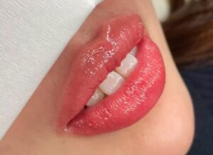 Sau khi khử thâm môi nữ có bị sưng hay khô môi không?