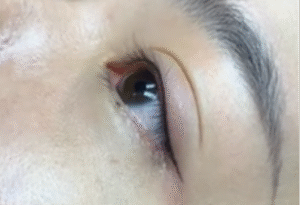 Mắt sau phun mí sưng bao lâu là bình thường?