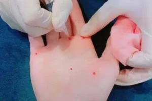 Co nen xam not ruoi son de doi van may khong.jpg