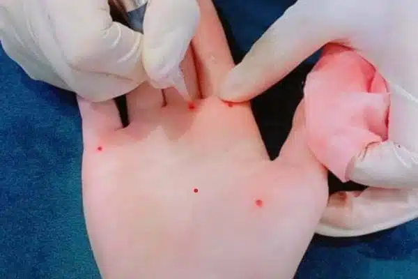 Vì sao nốt ruồi son sau khi xăm có thể bị hỏng? Vì sao nốt ruồi son sau khi xăm có thể bị hỏng?