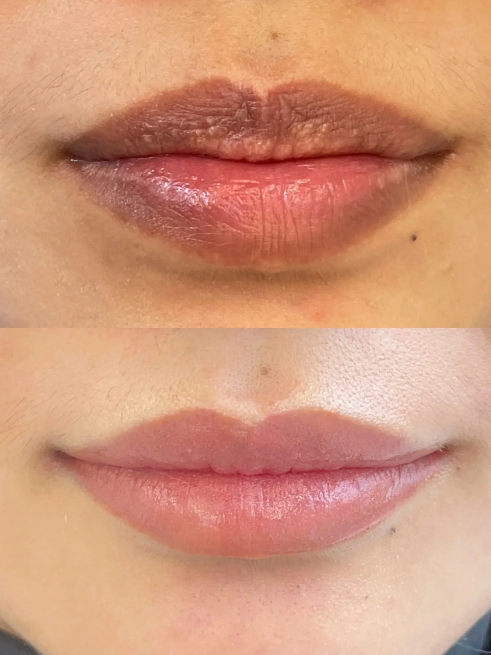 Môi quá thâm có cần laser trước khi phun? 3 IMG 6711 scaled