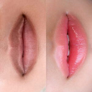 Khử thâm môi – bước đầu tiên để lấy lại thần thái tươi sáng