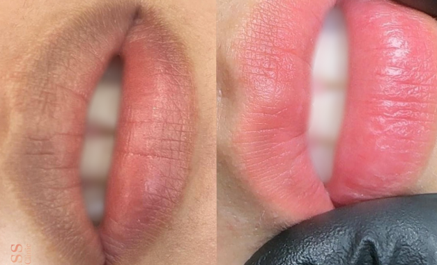Sau khi khử thâm môi nên kiêng gì để môi lên màu chuẩn nhất? 1 Khử thâm môi là gì?