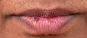 khử thâm môi nhanh phù hợp với ai? dấu hiệu bạn cần xử lý thâm ngay