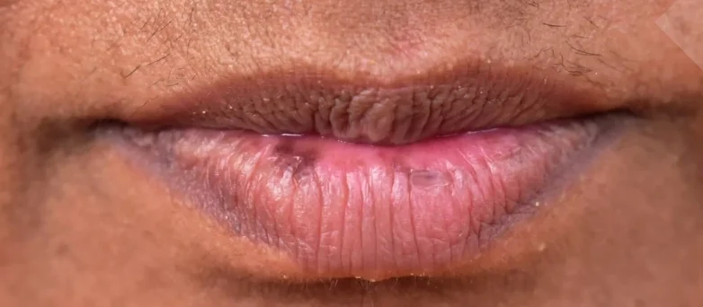 khử thâm môi nhanh phù hợp với ai? dấu hiệu bạn cần xử lý thâm ngay