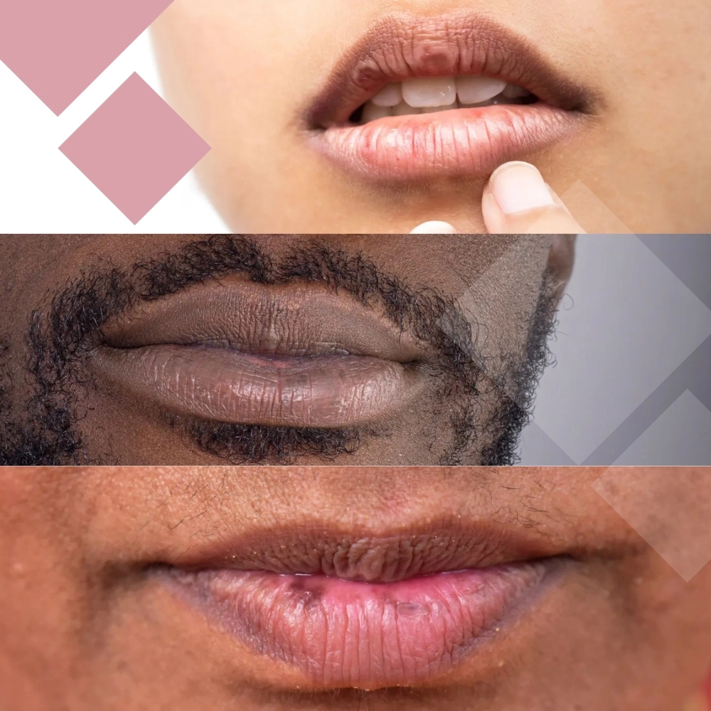 Laser Treatment for Lip pigmentation 1