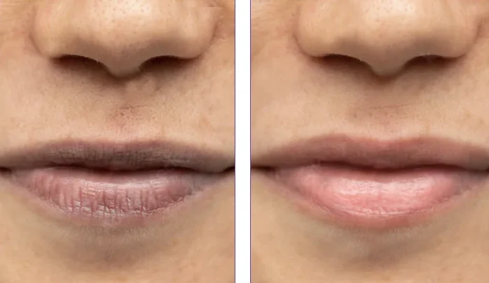 Lip Pigmentation Before After 1 e1761273665206