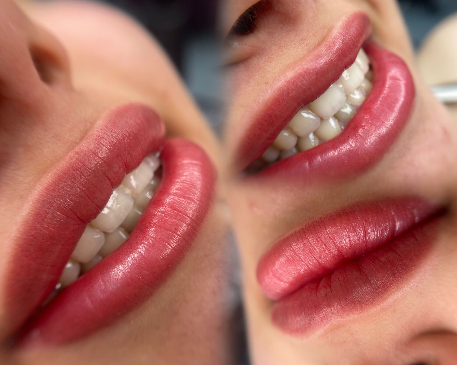 5 lỗi kỹ thuật khiến môi khử xong vẫn xỉn