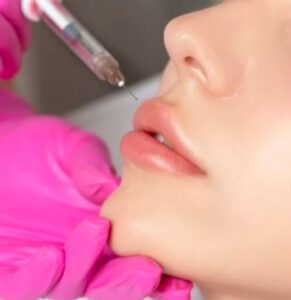 Môi đã từng tiêm filler có nên phun không?