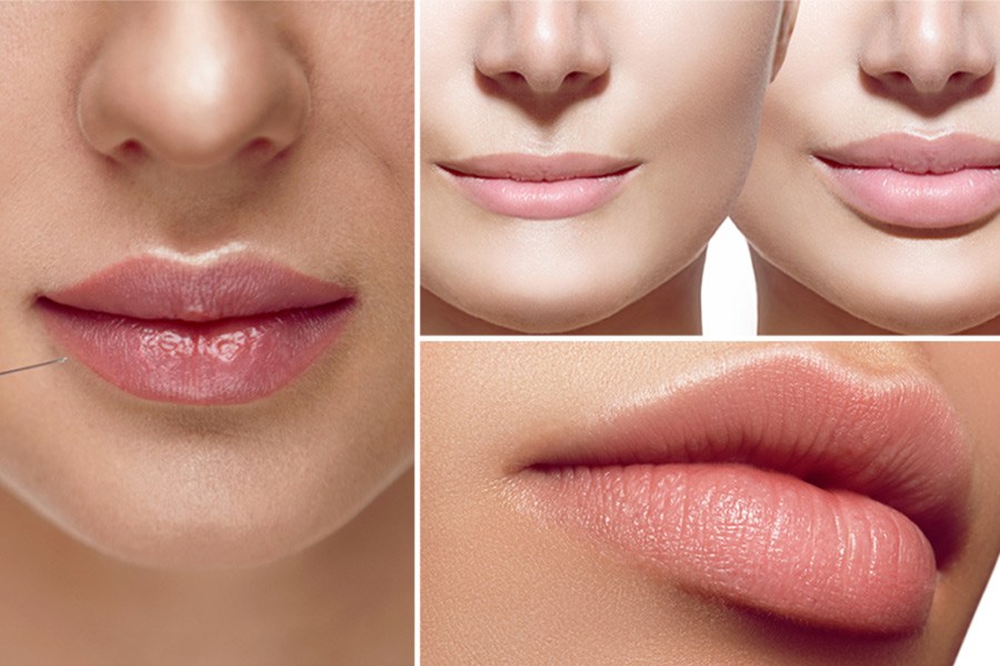 Biến chứng tắc mạch khi tiêm filler môi 