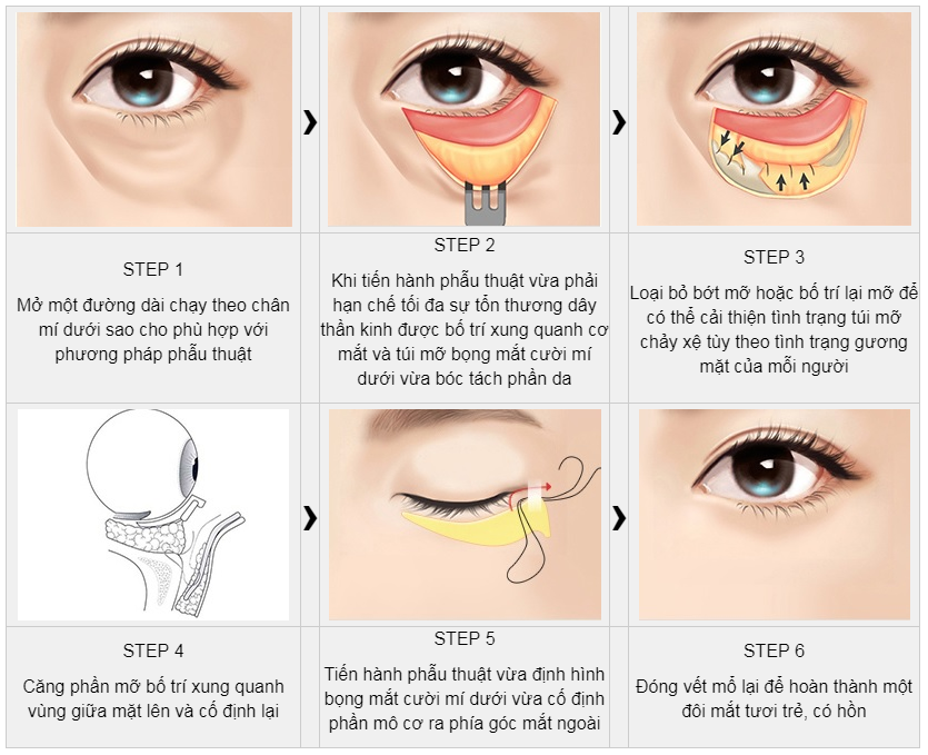 bien chung thuong gap khi cang da mat midface