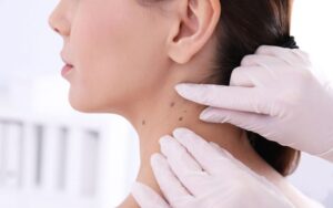 bieu hien cua not ruoi khong dien hinh nhu the nao 1 0fe664a2e5