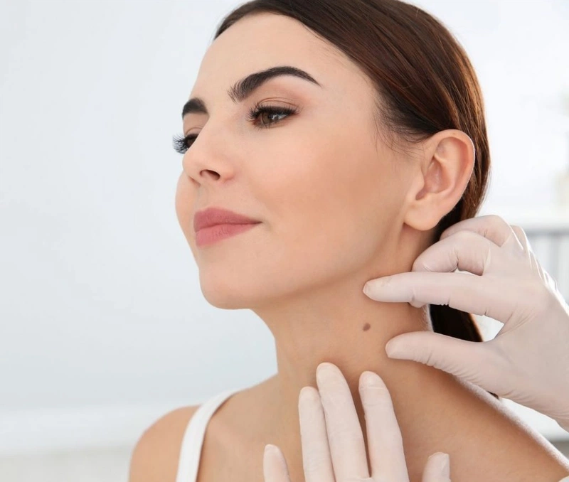 Cách tẩy xóa nốt ruồi an toàn tại nhà Cách tẩy xóa nốt ruồi an toàn tại nhà