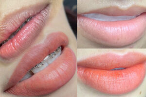 Khử thâm môi nữ là gì?