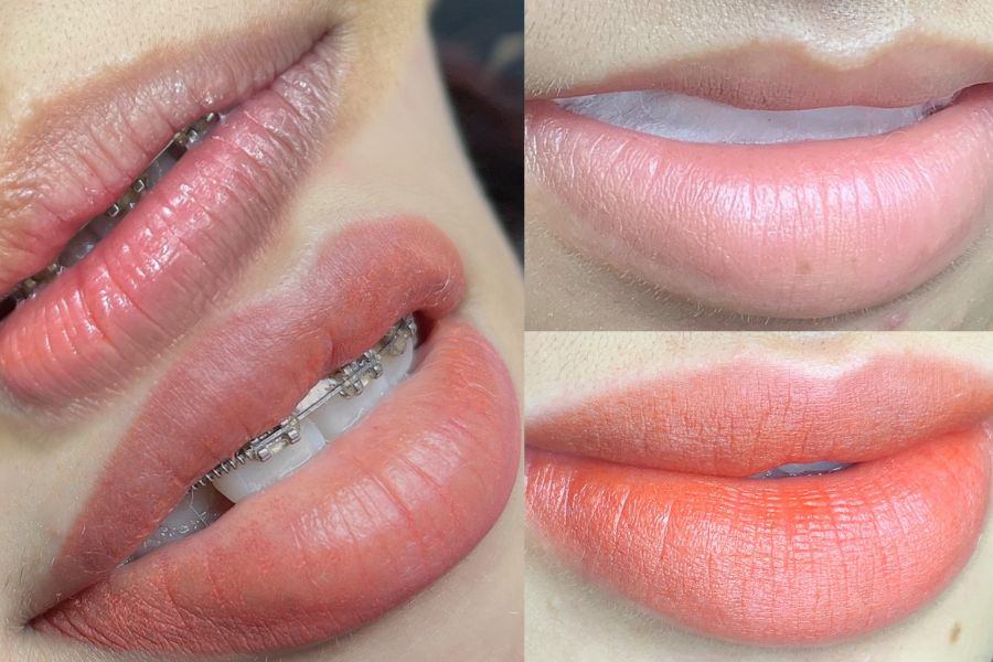 Khử thâm môi nữ là gì? Ai nên thực hiện phương pháp này? 1 Khử thâm môi nữ là gì?