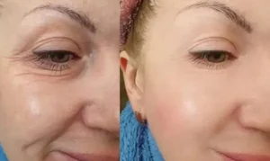 Căng da mí dưới