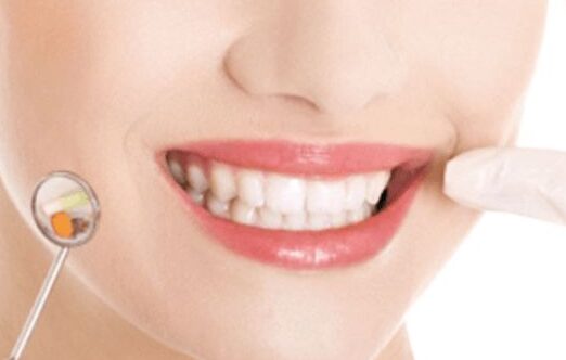 Mí phun khi vừa lấy cao răng, phẫu thuật răng – có nên trì hoãn? 3 cao rang la gi e1760668561944