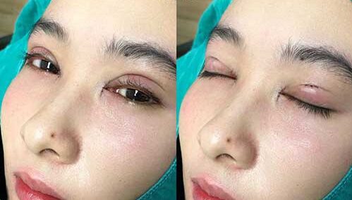 Vì sao nhiều người chọn phun mí sau khi cắt mí? 4 cat mi sau 1 thang e1759826655992