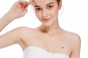 Nốt ruồi son ở ngực là gì?