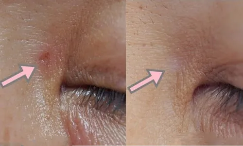 Đốt mụn thịt bao lâu thì lành?