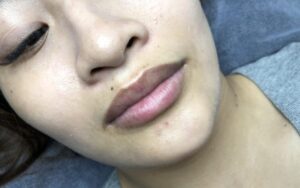 Vì sao môi thâm bẩm sinh khó khử hơn môi thâm do thói quen?