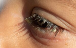 Vì sao sau phun mí bị đổ ghèn nhiều?