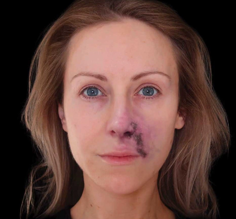 Dấu hiệu tiêm filler mũi bị hoại tử là gì là thắc mắc của rất nhiều chị em đam mê làm đẹp