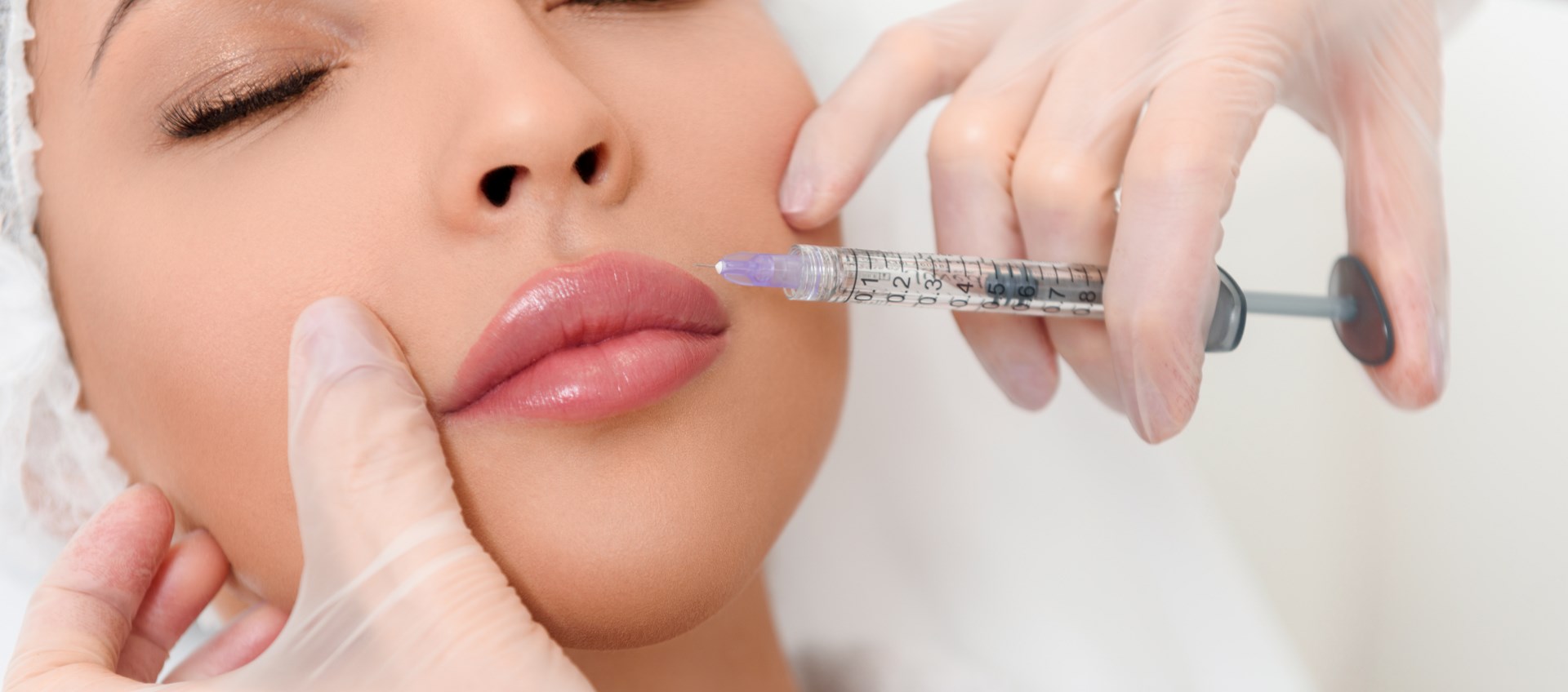 Sau khi tiêm filler môi nên ăn gì và kiêng gì? 3 dermal fillers and granulomas