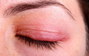 Cách xử lý khi bị dị ứng thuốc uốn mi nhanh chóng