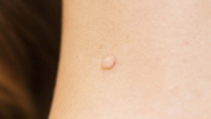 dot mun thit gia bao nhieu cach cham soc sau khi dot mun thit 1 43c75f5fd1