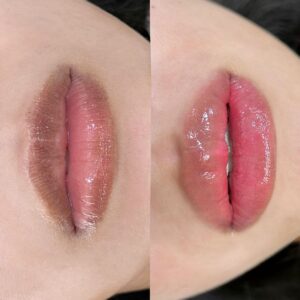 Môi quá thâm có cần laser trước khi phun?