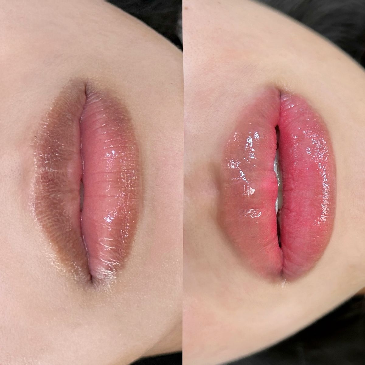 Môi quá thâm có cần laser trước khi phun?