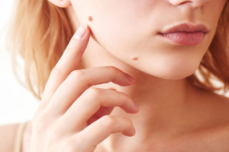 Đốt nốt ruồi là gì? Đốt nốt ruồi là gì?