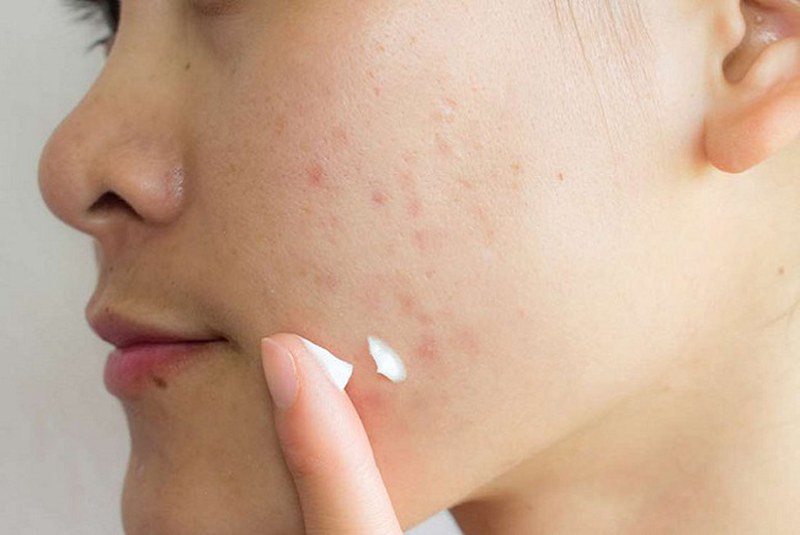 Tẩy nốt ruồi bao lâu thì bôi kem trị sẹo? Chăm sóc sau tẩy nốt ruồi 2 "Tẩy nốt ruồi bao lâu thì bôi được kem trị sẹo?" là thắc mắc của nhiều người