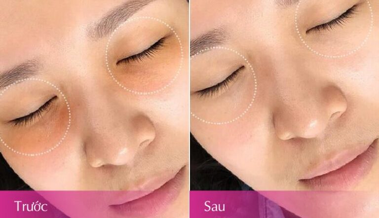 Phun mí và điều trị quầng thâm bằng laser – nên kết hợp hay hạn chế? 3 hieu qua khach hang sau khi tri tham quang mat tai zema 768x576 1 e1760705748225