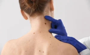 hinh anh not ruoi ung thu hac to 5 3069c8d2d8