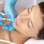 how long after lip fillers can you kiss featured