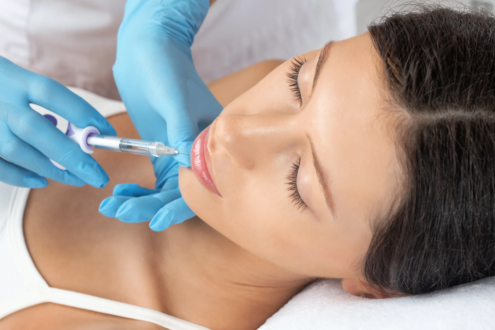 Filler môi bao lâu thì tan hoàn toàn?