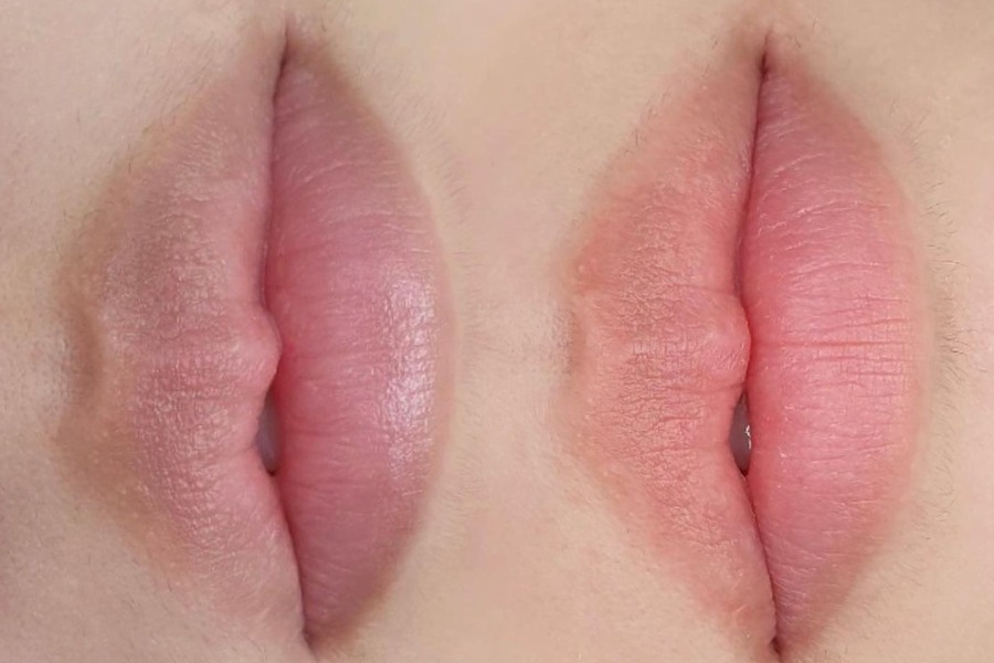 Khử thâm môi là gì?