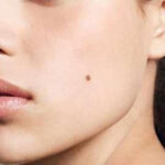 Liệu sau khi tẩy nốt ruồi có được ăn đồ ngọt không?