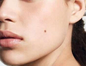 Liệu sau khi tẩy nốt ruồi có được ăn đồ ngọt không?