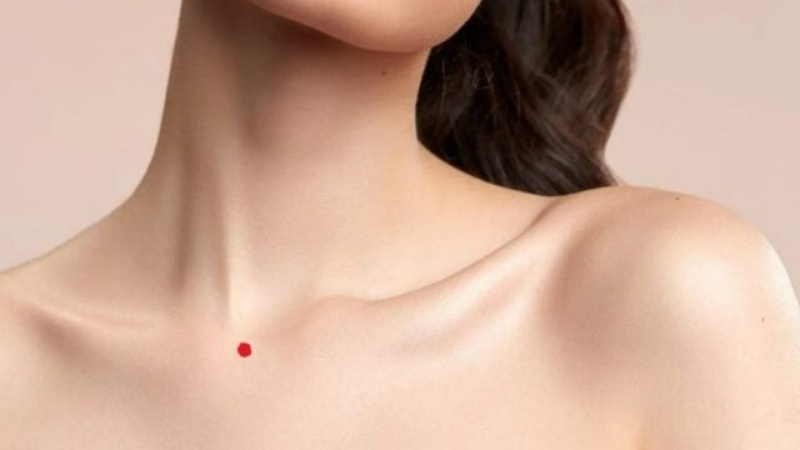 Nốt ruồi son ở cổ có ý nghĩa gì? Có nên xăm thêm để hút may mắn? 1 Nốt ruồi son ở cổ là gì?