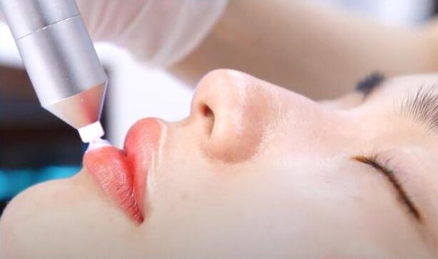 Công nghệ plasma trong khử thâm môi có thực sự “cứu vãn” mọi sắc tố?