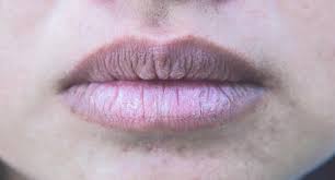 Những dấu hiệu cho thấy bạn đã đến lúc cần khử thâm môi ngay! 1 images 1 2