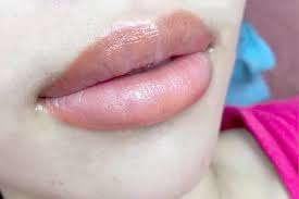 Tại sao khử thâm môi xong màu không đều? Cách khắc phục hiệu quả 1 Khử thâm môi xong màu không đều