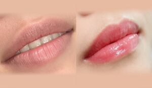 Vì sao nên khử thâm trước và phun màu sau ít nhất 20 ngày?