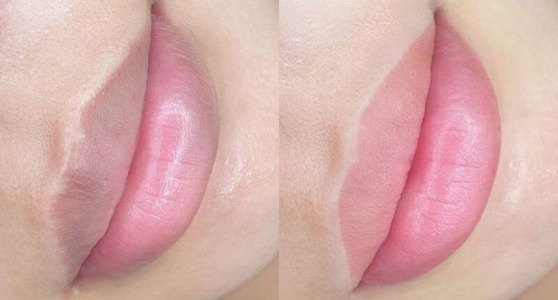 Khử thâm môi cho nữ Khử thâm môi cho nữ