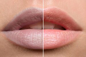 Màu nền khử thâm lý tưởng cho môi tím bẩm sinh là màu gì?